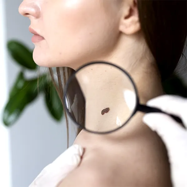 Img-clinica-estetica-bogota-Servicio-Retiro_de_lunares