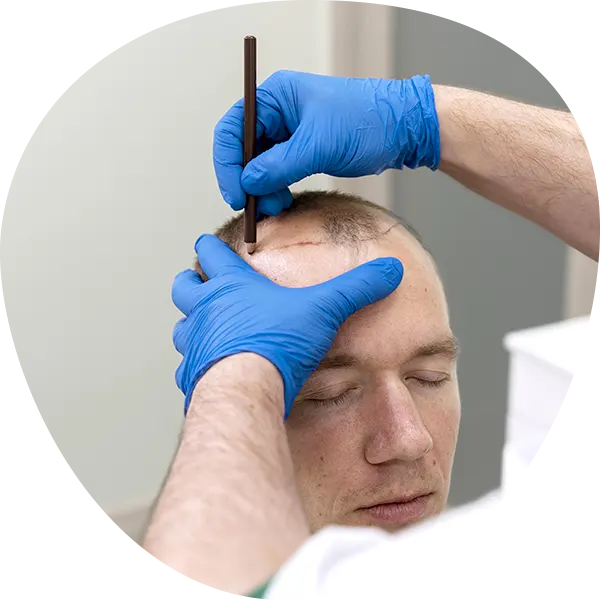 img-implante-capilar-en-bogota-1