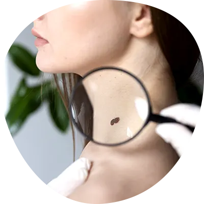 img-mole-removal-bogota-1-LCP