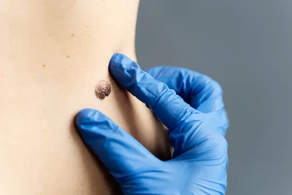 ¿Quieres deshacerte de esos lunares en el rostro que afectan tu confianza? Explora esta guía rápida de cómo eliminar lunares de la cara en 3 días, con métodos seguros y...