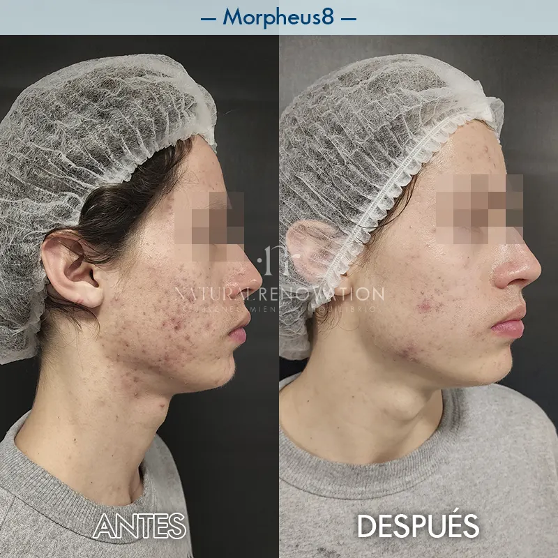 Img-Natural_Renovation-Antes&Despues-Morpheus8-1